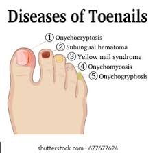 Image result for Yellow nail syndrome feet