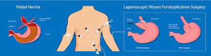 Maybe you would like to learn more about one of these? Hiatal Hernia Acid Reflux Symptoms The Surgical Clinic