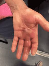 Image result for phlegmon of hand)