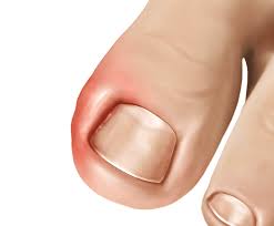 Image result for Toenail Removal