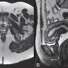 Maybe you would like to learn more about one of these? Normal Female Pelvis Axial A And Sagittal B Mri T2 Weighted Images Download Scientific Diagram