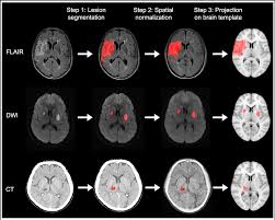 Image result for Neurologic Lesion Localization