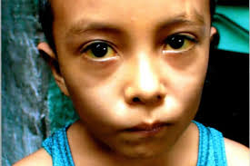 Fundraiser by Giannina Fredo : Help Numan Pay For His Liver Transplant