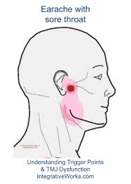 Pin On Tmj Trigger Point Pain