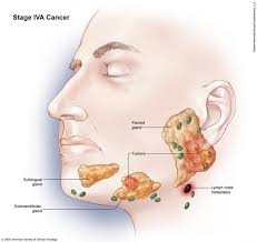 Lymph node cancer symptoms in hodgkin's lymphoma. Salivary Gland Cancer Stages And Grades Cancer Net