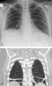 The Lung In Systemic Lupus Erythematosus Musculoskeletal Key
