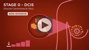 How to answer how are you in formal and informal ways with esl image. Stages 0 1 National Breast Cancer Foundation