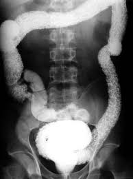 The inflammation caused by crohn's disease often spreads deep into the layers of affected bowel tissue. Ulcerative Colitis Barium Enema Radiology Case Radiopaedia Org