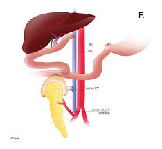 17 diagram of a pancreatic acinus and its duct system. D E F Illustration Of Tpiat And En Bloc Combined Liver Pancreas Download Scientific Diagram
