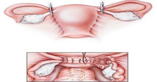 Clinically occult cervical cancer diagnosed after simple hysterectomy. Hysterectomy Why It S Done Risks What To Expect