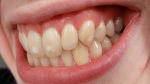 White Spots On Teeth In Children While Sick And More