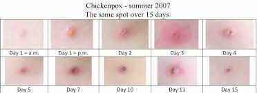 Pin On Chicken Pox