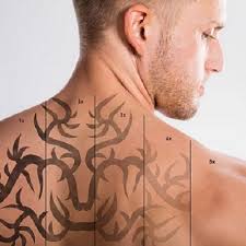Fortunately, many laser tattoo removal providers offer financing and/or payment plans for their clients to make laser tattoo removal more easily accessible. Picosure Laser Tattoo Removal In Dubai Abu Dhabi Enlighten Pico Cost