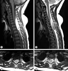 Neurospine