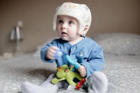 Environ 40% des bébés connaissent le phénomène de la tête plate appelé aussi plagiocéphalie. Encore Trop De Bebes A La Tete Plate La Presse