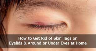 Hers Skincare Review Do Their Prescription Creams Work Skin Tag On Eyelid Skin Tag Removal Remove Skin Tags Naturally