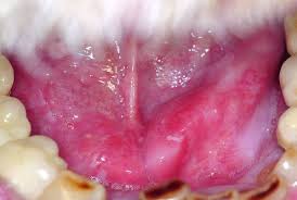 Hpv is the name of a very common group of viruses. Vitalpilze Heilpilze Und Deren Wirksamkeit Fur Den Menschlichen Organismus Hpv Mund Behandlung