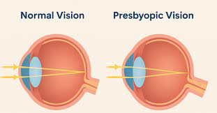 Image result for Presbyopia