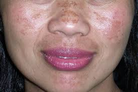 Image result for Melasma