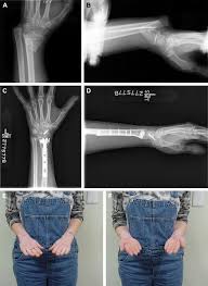 Image result for Galeazzi Sign