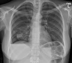 Endometriosis is more common in women who are having fertility issues, but it does not necessarily cause infertility. Thoracic Endometriosis Syndrome Manifesting As Atraumatic Haemothorax Causing Difficult Ventilation Under General Anaesthesia Bmj Case Reports