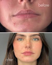 Dr. Pflederer is truly an artist. ✨ Just look at this stunning lip  transformation for this beautiful mother-daughter duo. Ready for your own  glow-up? Book with Dr. Pflederer between May 5–9 to
