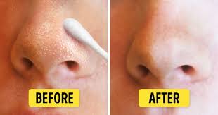 For more advice on how to get rid of pimples fast, don't miss: 8 Natural Ways To Get Rid Of Blackheads And Whiteheads Fast