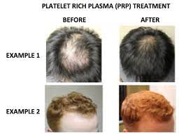 There are a few exceptions you should note. Platelet Rich Plasma Prp Treatments Donovan Hair Clinic