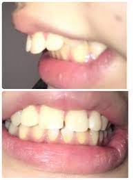 名無しのがるび 2021/05/27(木) 12:46:23.92 id:fw0hgp2qm.net >>99 åˆã‚ã¾ã—ã¦ 25æ­³ã®å¥³ã§ã™ å‡ºã£æ­¯ãŒã‚³ãƒ³ãƒ—ãƒ¬ãƒƒã‚¯ã‚¹ã§æ­¯åˆ—çŸ¯æ­£ã‚'è€ƒãˆã¦ã„ Yahoo çŸ¥æµè¢‹