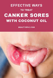 Biting The Inside Of Your Cheek Treatment Effective Ways To Treat Canker Sores With Coconut Oil Canker Sore Cankers Essential Oils Canker Sore