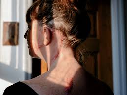 The appearance of skin cancer on the scalp will vary depending on the type of skin cancer. I Ve Had Skin Cancer Removed Again And Again And Again Chatelaine