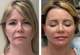 minifacelifting #minifaceliftbeforeandafter #blepharoplasty #facelift  #faceliftmichigan #faceliftbeforeandafter #cosmeticsurgery #faceliftexpert  #faceliftspecialist#necklift#skincare  #skinandveincente#liplift#naturallook#botox#daxxify ...