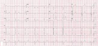 The qt interval is less relevant in the setting of bbb (bbb by itself may prolong the qt). St Elevation Myocardial Infarction In Lbbb Core Em