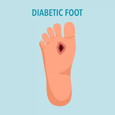 Image result for diabetic toes