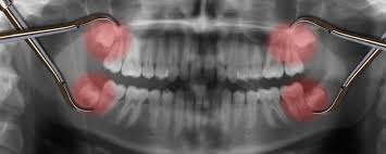 How much you can expect to pay out of pocket for wisdom teeth removal, including what people paid. Wisdom Teeth Removal Wisdom Tooth Extraction Mga Dental