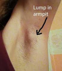 Pin On Breast Implant Illness