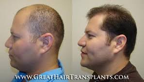 Best Rated Hair Transplant Doctor in Florida Hillsborough Aarons Place