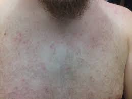 Sympthom bintik merah di badan. Biang Keringat Wikipedia Bahasa Indonesia Ensiklopedia Bebas