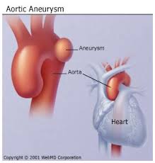 An aneurysm is a weak point in a blood vessel wall, most commonly in an artery. What Is An Aneurysm Types And Causes