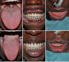 New Surgical Method Of Tongue Reduction For Macroglossia Technical Note Sciencedirect