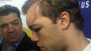 Either that, or your intention is to avoid injury and risk not being able to make a trade. Hall Fortunate Injury Isn T More Severe Sportsnet Ca