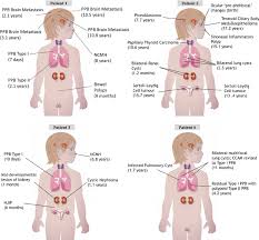 Small cell (oat cell) lung cancer. Lung Cancer In Children Causes Types Symptoms And Treatments