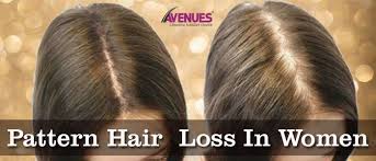 Pattern Hair Loss In Women Hair Loss Women Male Pattern Baldness Hairstyles Female Pattern Hair Loss
