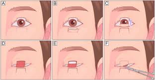 Image result for Eyelid Closure Defect