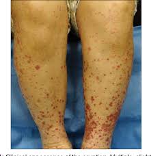 Senile purpura may also be known as bateman's purpura or actinic purpura. Figure 1 From Henoch Schonlein Purpura Iga Vasculitis Developing After Postoperative Wound Infection By Methicillin Resistant Staphylococcus Aureus Semantic Scholar