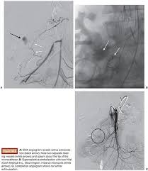 Image result for Colonoscopy in GI Bleeding