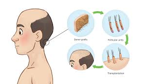As you age, your body's testosterone levels will also increase. Male Pattern Baldness Doctors Australia