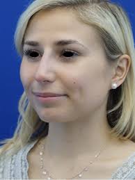 Cases in Liquid Rhinoplasty