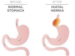 The time that it takes is very individual. Hiatal Hernia Surgery Procedure Recovery And Outlook