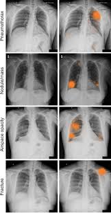 Image result for Chest XRay Interpretation